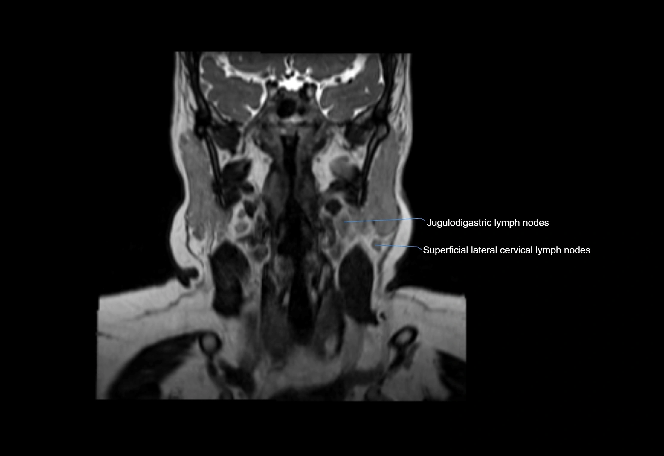 Neck coronal lymph node cross sectional MRI anatomy 3T MRI  image-img-00001-00042.webp